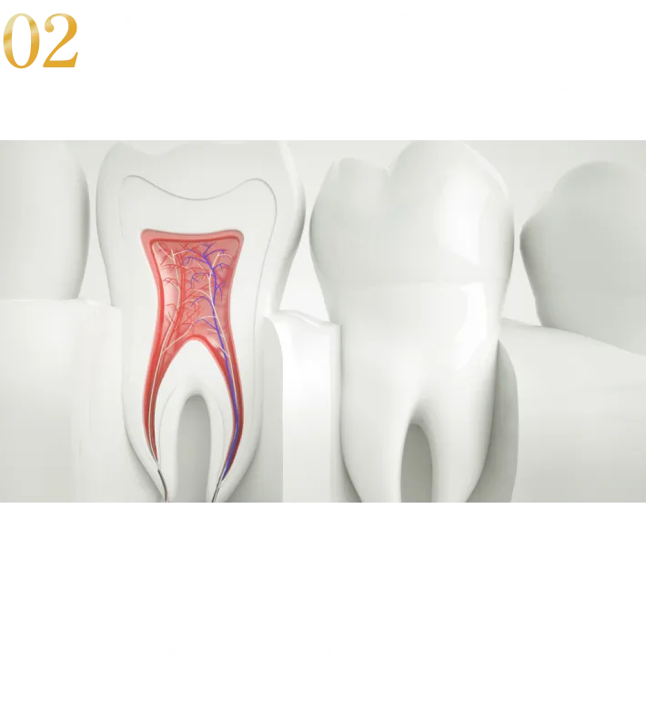 2:インプラント埋入前の徹底した歯周病コントロール