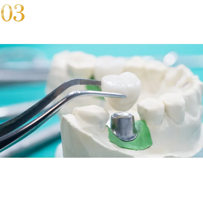 3:耐久性の高い上部構造ジルコニアを選択