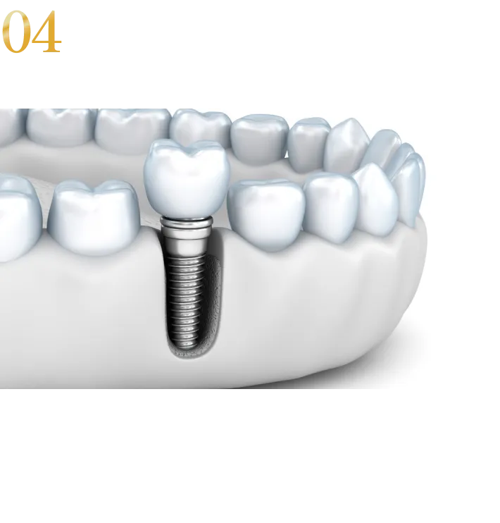 4:上部構造の固定はスクリューリテイン